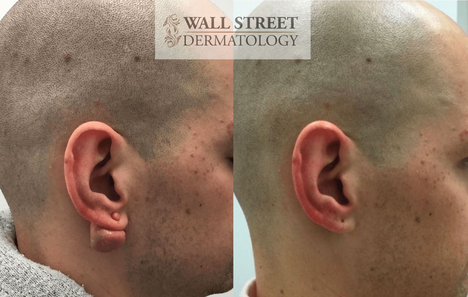 Before & After Gallery Wall Street Dermatology
